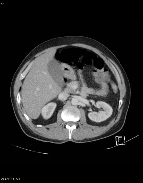 File:Boerhaave syndrome with tension pneumothorax (Radiopaedia 56794-63603 A 22).jpg