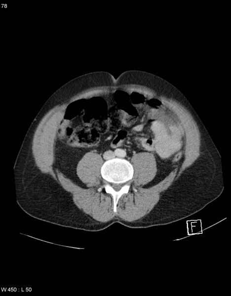 File:Boerhaave syndrome with tension pneumothorax (Radiopaedia 56794-63603 A 39).jpg