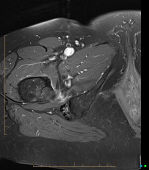 File:Bone metastasis - breast cancer (Radiopaedia 16667-16374 Axial T1 C+ fat sat 3).jpg