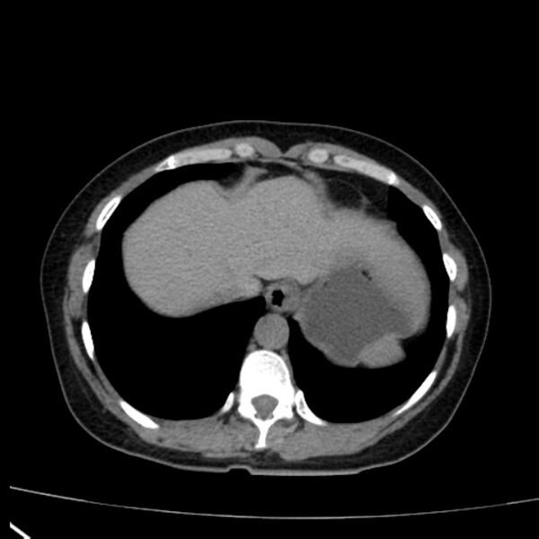 File:Bosniak renal cyst - type I (Radiopaedia 27479-27675 Axial non-contrast 10).jpg