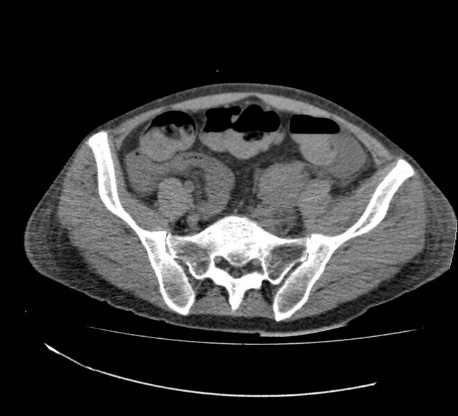 File:Bowel lymphoma complicated by bleeding after therapy (Radiopaedia 55601-62110 Axial non-contrast 63).jpg