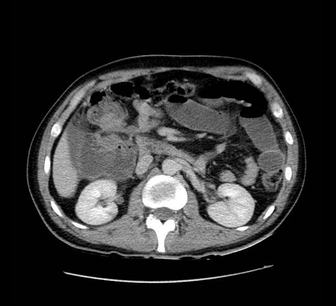 File:Bowel obstruction from colon carcinoma (Radiopaedia 22995-23028 A 32).jpg