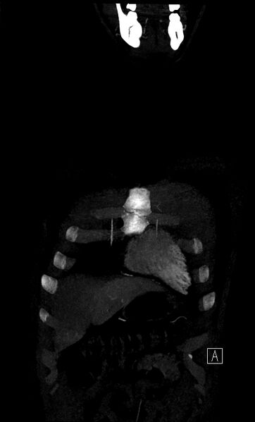 File:Brachiocephalic trunk pseudoaneurysm (Radiopaedia 70978-81191 B 10).jpg