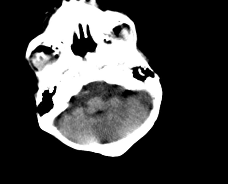 File:Brachycephaly (bi-coronal and bi-lambdoid synostosis) (Radiopaedia 55048-61413 Axial non-contrast 12).jpg