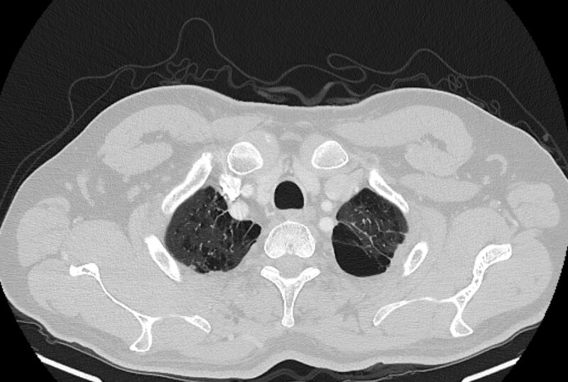 File:Brain metastases - lung cancer primary (Radiopaedia 75060-86116 Axial lung window 4).jpg