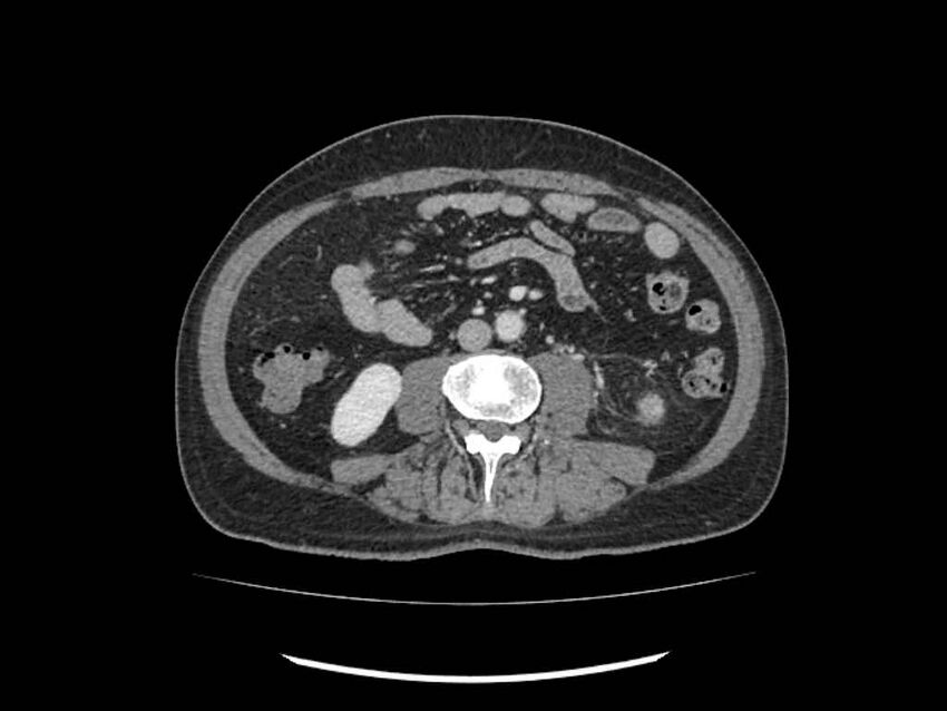 Brain metastases from renal cell carcinoma (Radiopaedia 42222-45328 B 160).jpg
