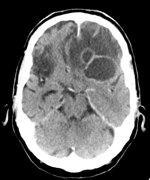 File:Brain metastasis (lung cancer) (Radiopaedia 48289-53177 Axial C+ 10).png