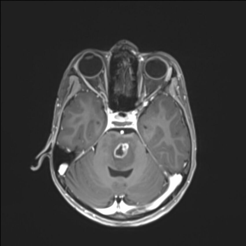 Brainstem glioma (Radiopaedia 70548-80674 Axial T1 C+ 54).jpg
