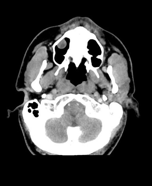 File:Branchial cleft cyst (Radiopaedia 31167-31875 Axial C+ delayed 7).jpg