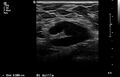 Breast cancer and multiple circumscribed masses (Radiopaedia 62456-70700 A 7).jpeg