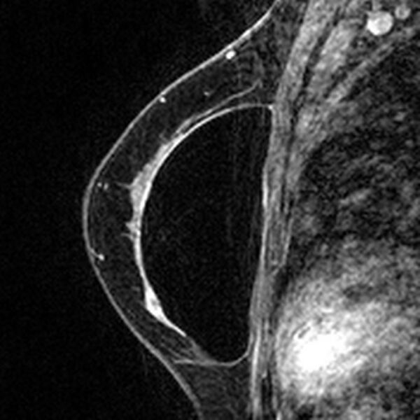 File:Breast implants - MRI (Radiopaedia 26864-27035 Sagittal T2 34).jpg