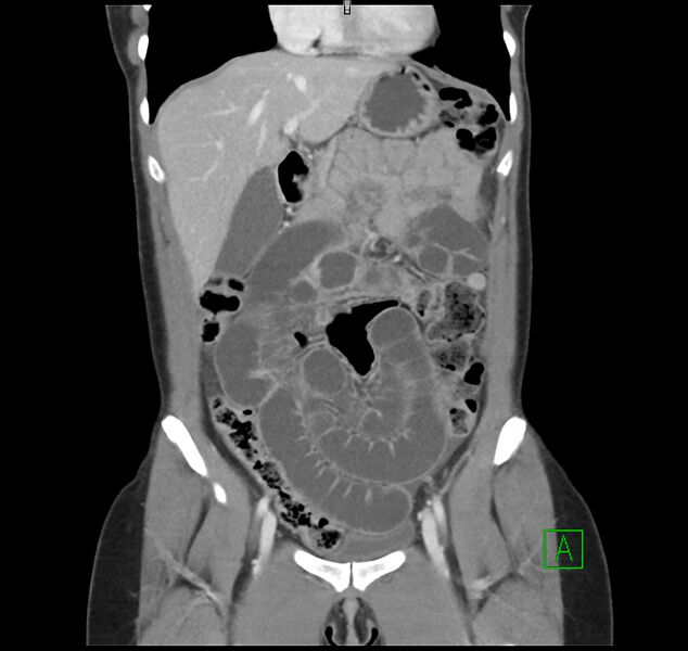 File:Broad ligament hernia (Radiopaedia 63260-71832 B 12).jpg