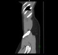Broad ligament hernia (Radiopaedia 63260-71832 C 51).jpg