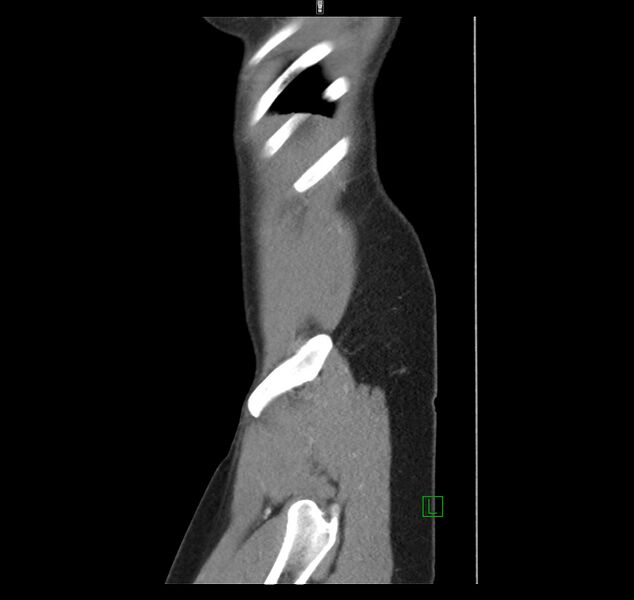 File:Broad ligament hernia (Radiopaedia 63260-71832 C 51).jpg