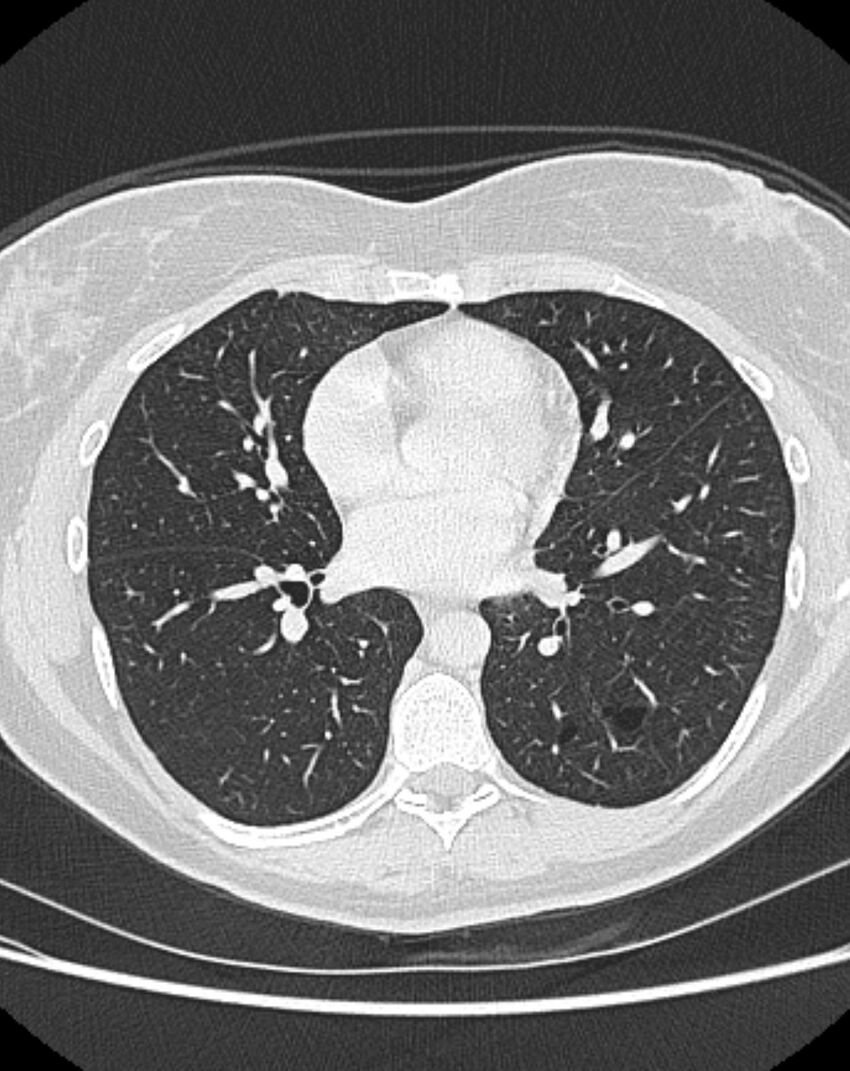 Bronchial atresia (Radiopaedia 50007-55297 Axial lung window 61).jpg