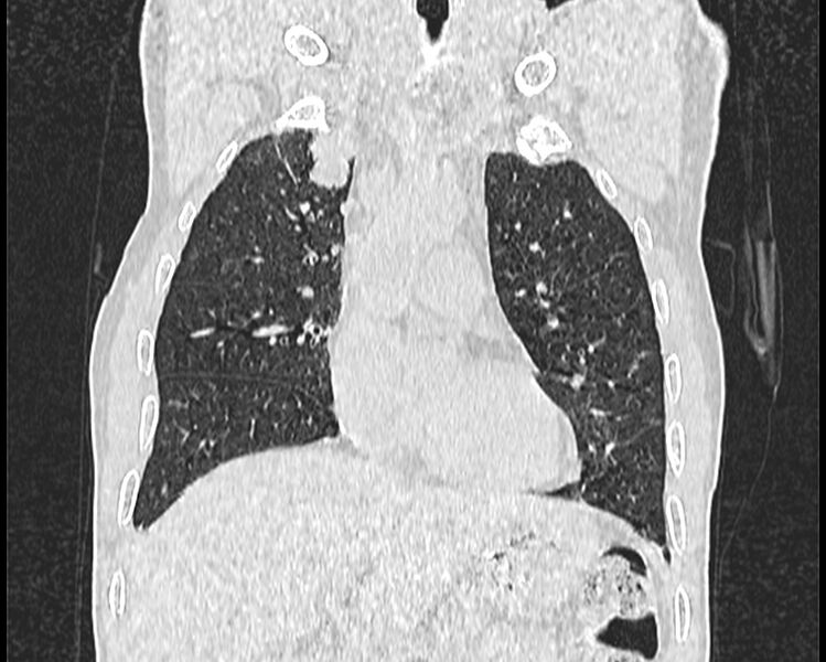 File:Bronchogenic carcinoma with superior vena cava syndrome (Radiopaedia 36497-38054 Coronal lung window 7).jpg