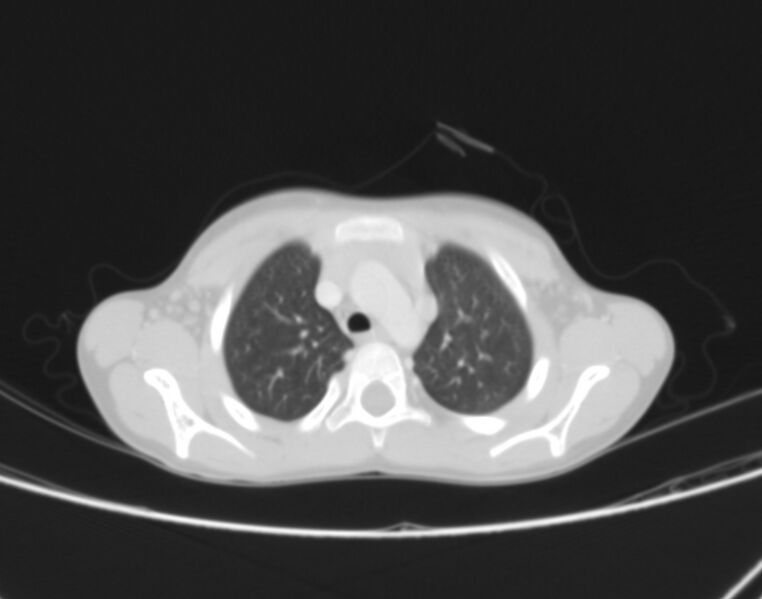 File:Bronchus suis (Radiopaedia 68131-77620 Axial lung window 7).jpg