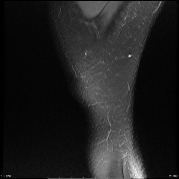 File:Bucket handle tear - lateral meniscus (Radiopaedia 7246-8187 Sagittal T2 fat sat 2).jpg