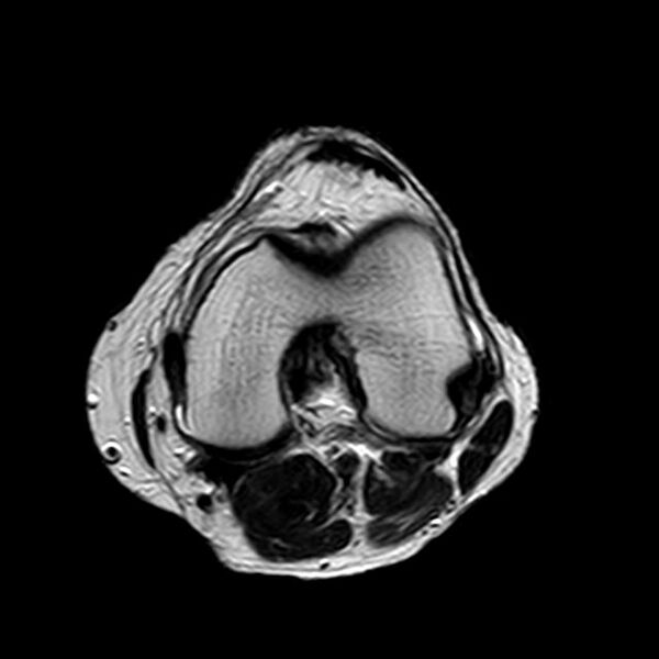 File:Bucket handle tear - medial meniscus (Radiopaedia 29250-29664 Axial T2 9).jpg