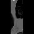 C5 facet fracture (Radiopaedia 58374-65499 Sagittal bone window 70).jpg