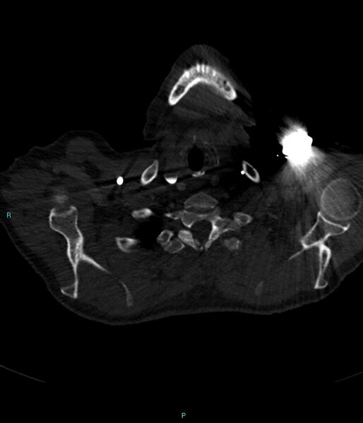 File:Calcified cerebral emboli from left ventricular thrombus (Radiopaedia 84420-99760 Axial bone window 3).jpg
