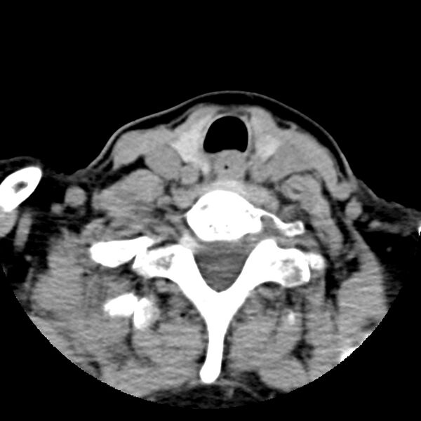 File:Calcified meningioma - cervical canal (Radiopaedia 70136-80171 B 30).jpg