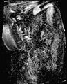 Cancer cervix - stage IIb (Radiopaedia 75411-86615 Sagittal ADC 22).jpg