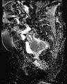 Cancer cervix - stage IIb (Radiopaedia 75411-86615 Sagittal ADC 8).jpg