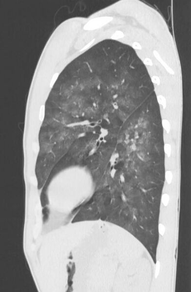 File:Cannabis-induced diffuse alveolar hemorrhage (Radiopaedia 89834-106946 Sagittal lung window 104).jpg