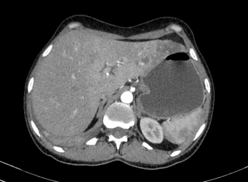 Cannonball metastases from breast cancer (Radiopaedia 91024-108569 A 115).jpg
