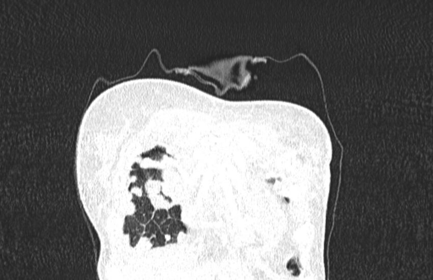 Cannonball metastases from breast cancer (Radiopaedia 91024-108569 Coronal lung window 13).jpg