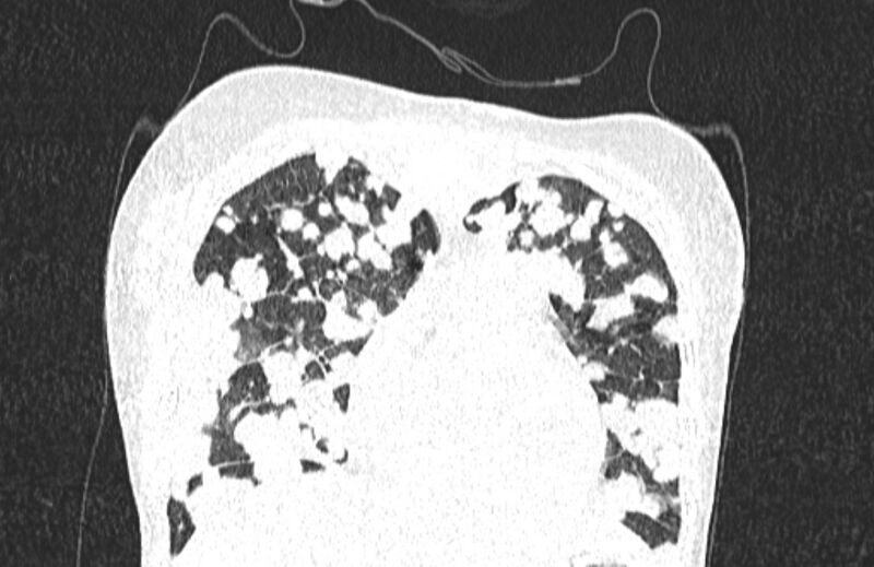 File:Cannonball metastases from breast cancer (Radiopaedia 91024-108569 Coronal lung window 37).jpg