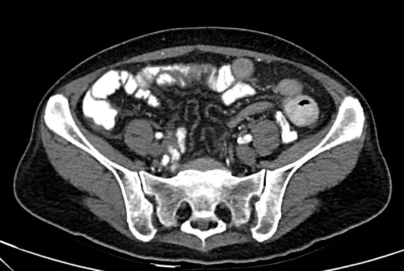 File:Carcinoid mesenteric tumor complicated by chylous ascites (Radiopaedia 76312-88926 A 53).jpg