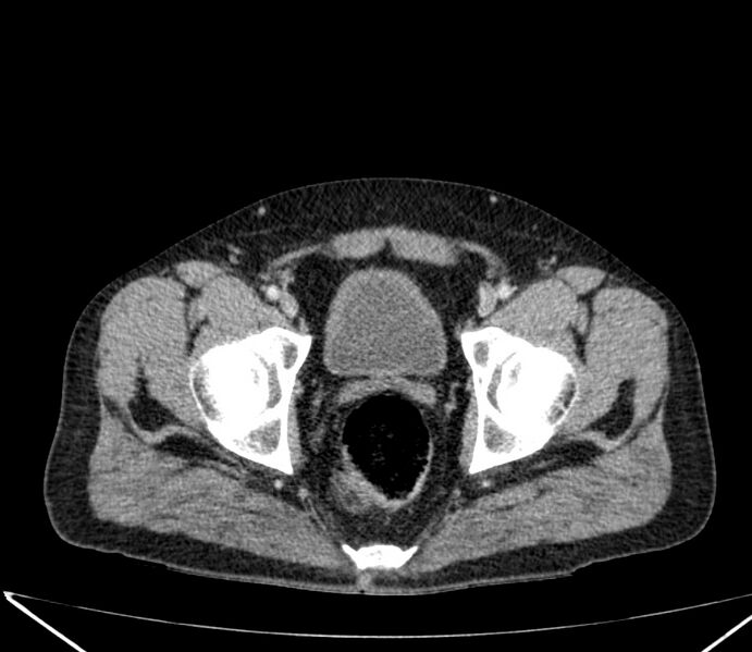 File:Carcinoid tumor with hepatic metastases (Radiopaedia 22651-22670 C 75).jpg