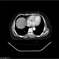 Carcinoma cervix- recurrence (Radiopaedia 34702-36137 B 5).jpg