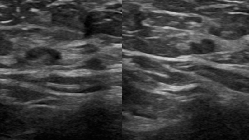 File:Carcinoma right breast with metastatic lymphadenopathy (Radiopaedia 30584-31240 Axilla 1).png