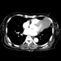Cardiac fibroma (Radiopaedia 38974-41149 A 5).jpg