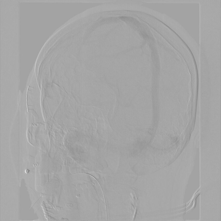 Caroticocavernous fistula - direct (Radiopaedia 61660-69666 Oblique Left ICA 65).jpg