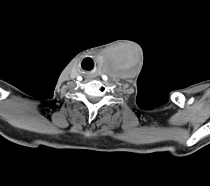 File:Carotid artery pseudoaneurysm (Radiopaedia 84030-99259 C 59).jpg