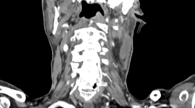 File:Carotid artery pseudoaneurysm (Radiopaedia 84030-99259 D 57).jpg