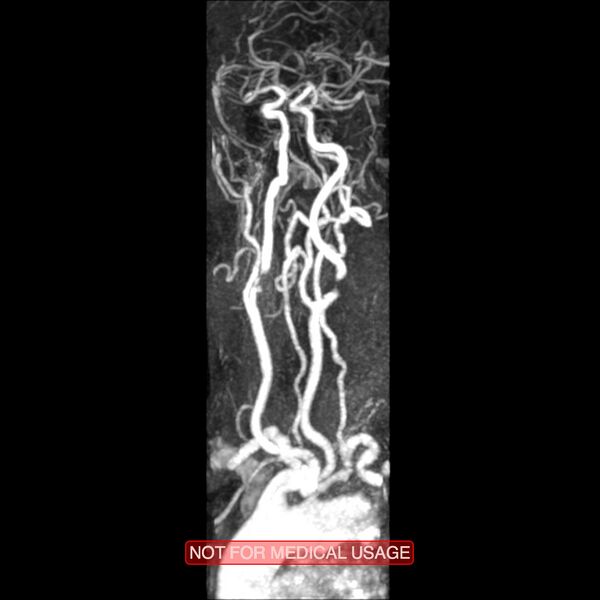 File:Carotid artery stenosis (Radiopaedia 28786-29087 3D MRA 13).jpg
