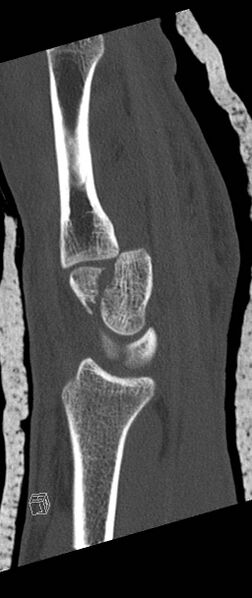 File:Carpal fractures (smart watch impaction) (Radiopaedia 55844-62430 Sagittal bone window 23).jpg