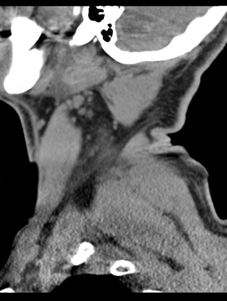 File:Cavernoma of cervical cord (Radiopaedia 50838-56346 B 9).png