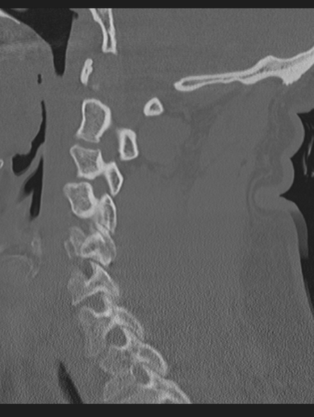 File:Cavernoma of cervical cord (Radiopaedia 50838-56346 Sagittal bone window 34).png