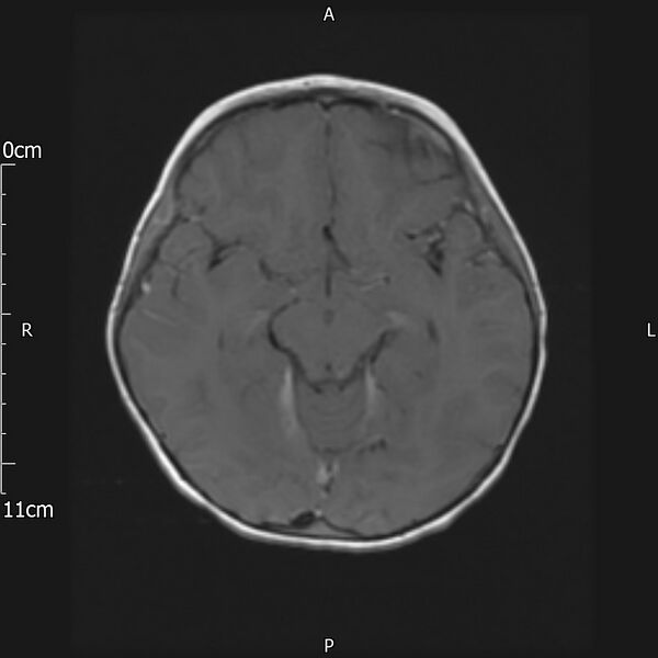 File:Cavernous sinus thrombosis (Radiopaedia 79414-92512 Axial T1 C+ 13).jpg