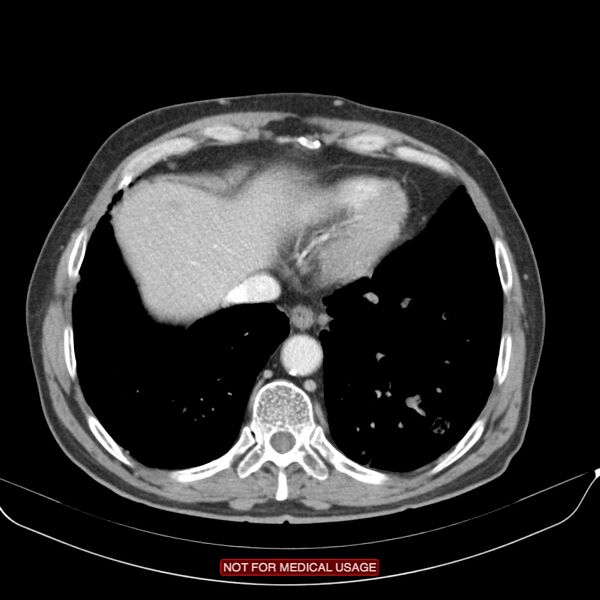 File:Cavitating pulmonary metastases (Radiopaedia 24920-25184 B 23).jpg