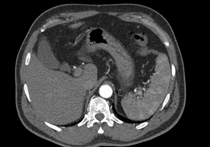 File:Celiac artery dissection (Radiopaedia 52194-58080 A 17).jpg