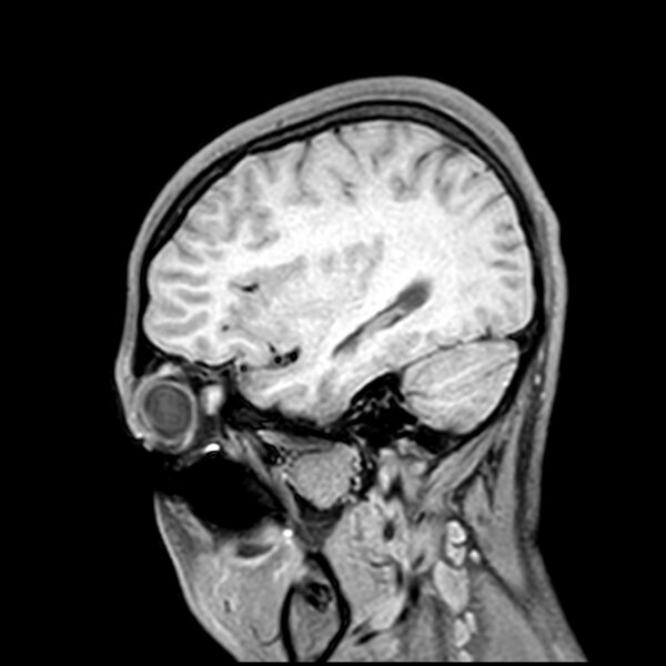 File:Central neurocytoma (Radiopaedia 79320-92380 Sagittal T1 72).jpg