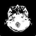 Cerebellar abscess secondary to mastoiditis (Radiopaedia 26284-26412 Axial non-contrast 17).jpg
