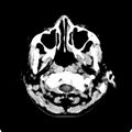 Cerebellar abscess secondary to mastoiditis (Radiopaedia 26284-26412 Axial non-contrast 5).jpg